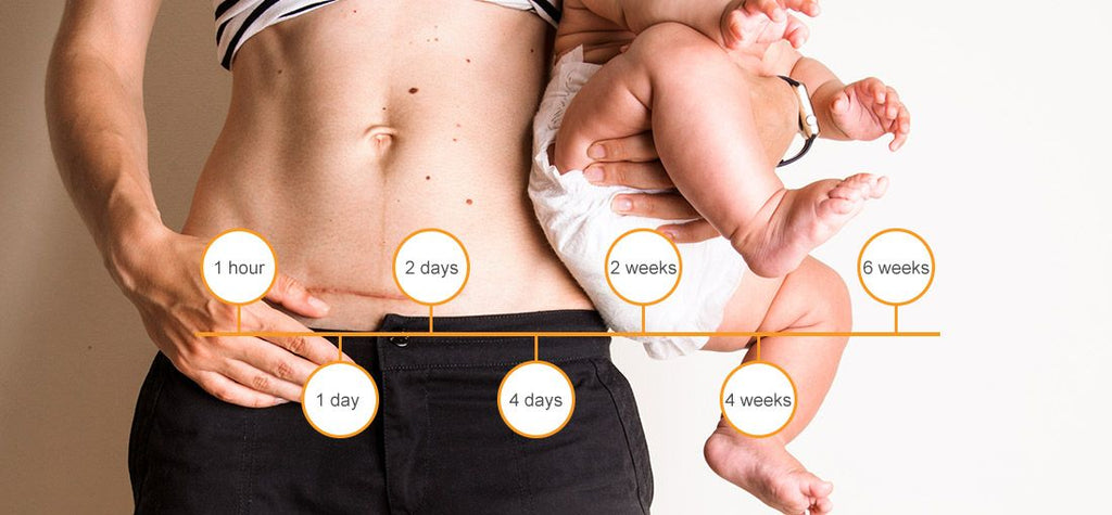 C-Section Recovery Week by Week: Timeline and Care Tips