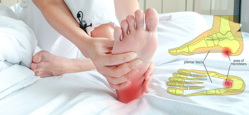 Webmd hot sale plantar fasciitis