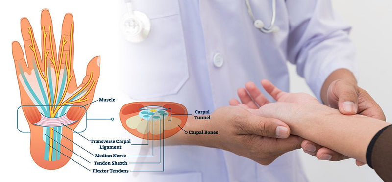 Carpal Tunnel in Hand