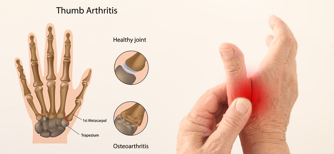 Thumb Arthritis