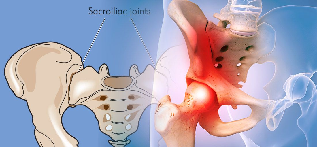 sacroiliac joint pain