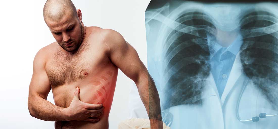Broken Rib Treatment