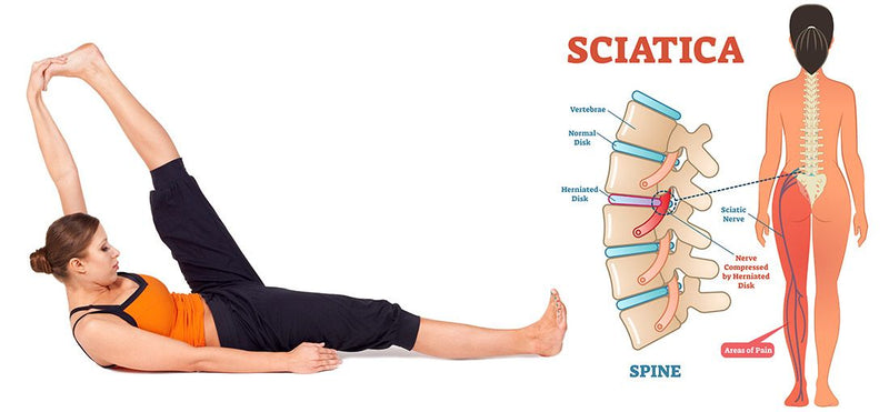 Sciatica Pain Exercise